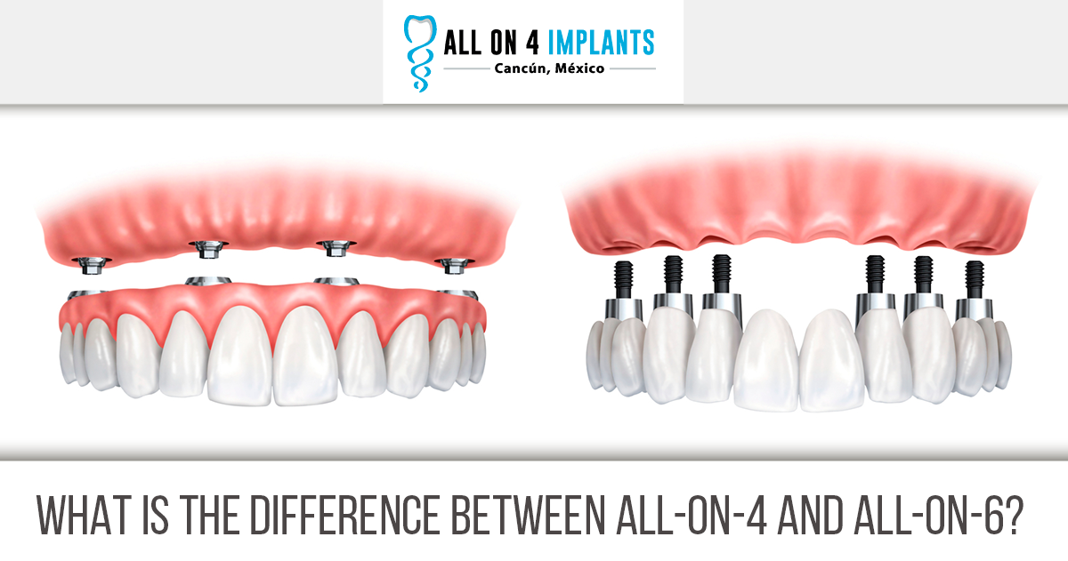 What is the difference between All-on-4 and All on 6 in Cancun?